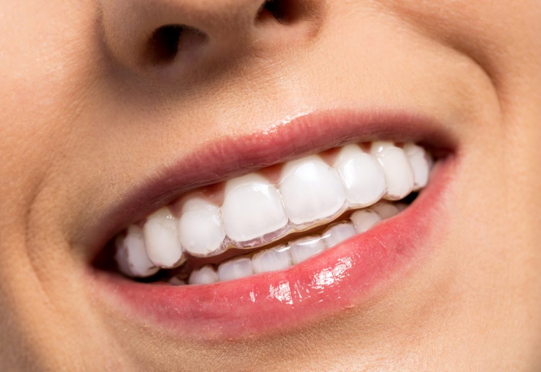 Invisalign® Clear Aligners