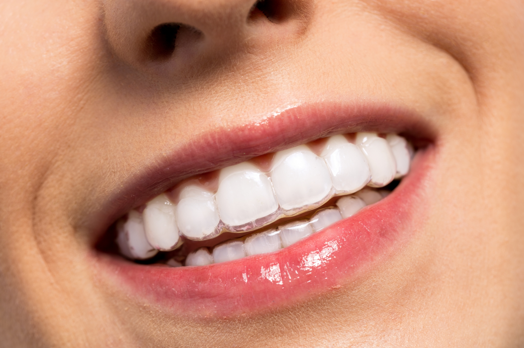 Invisalign® Clear Aligners