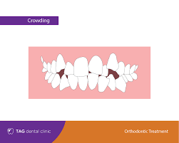 teeth crowding