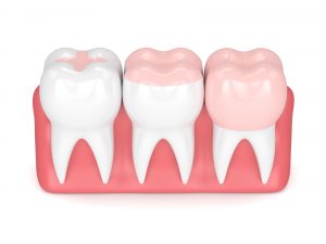 inlay-onlay-crown-dental filling